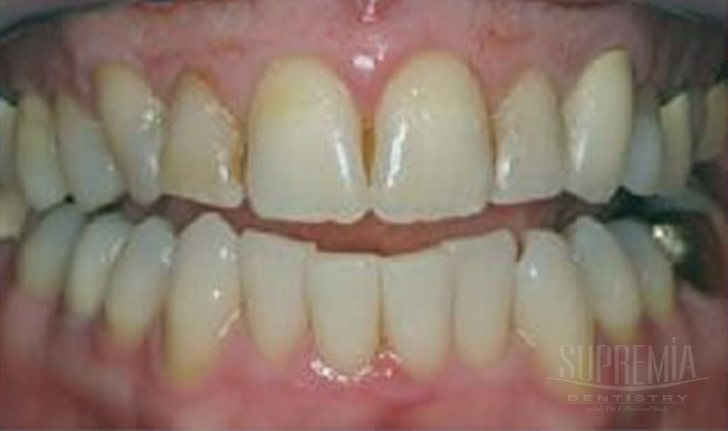 Before