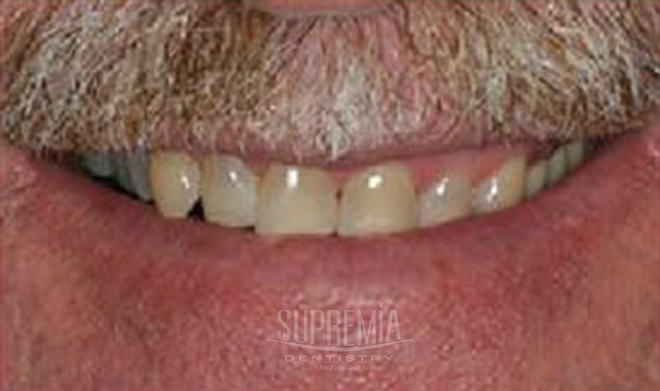 Before