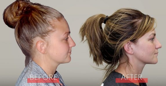 facial-growth-orthodontics-dr-green-courtney-before-after-agga facial-growth-orthodontics-dr-green-courtney-before-after-agga